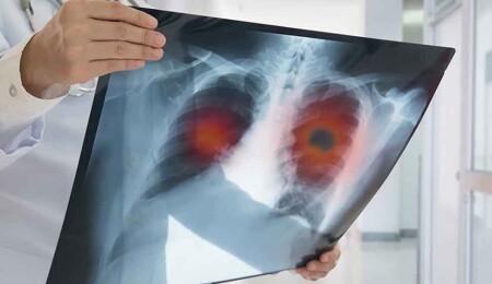 Tıpta yeni atılım: Agresif kanser hücreleri kasa dönüştürüldü