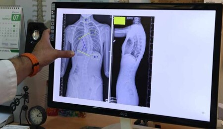 Çocuklarda ergenlik öncesi skolyoz kontrolü tedavi şansını artırıyor