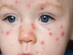 Limasol’da aynı aileden 5 kişide kızamık tespit edildi