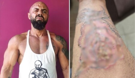 Gazimağusa’da yetkisiz lazer işlemi: Cenk Hoca üçüncü derece yanıkla hastaneye gitti