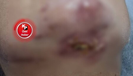 Dolgu işleminden sonra yüzü enfekte oldu: Yedi aydır bu acıyla yaşıyorum, muhatap bulamıyorum